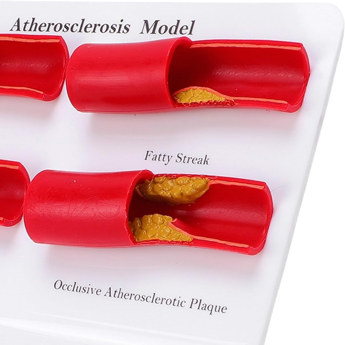 Menschliches Atherosklerosemodell, 4-stufiges pathologisches anatomisches Darstellungsmodell der Arterie, verwendet for medizinische Lehre und Demonstration der Physiologie des