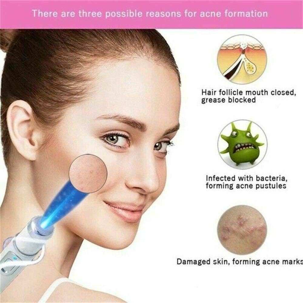 Penna Laser per Terapia a Luce Blu per vene varicose, Antirughe e Acne