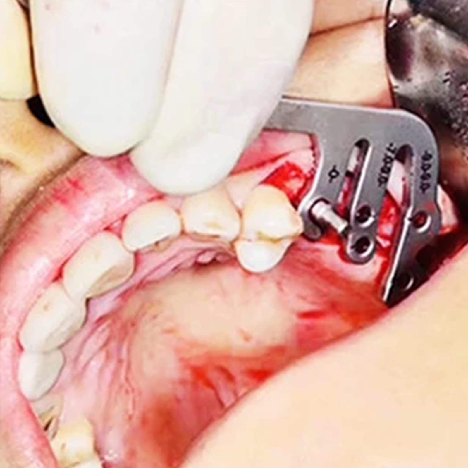 Guida All'impianto Dentale Impostare Oral Piantatura Posizionamento Guida Di Posizionamento Guida Per La Perforazione Posizionamento Del Righello Angolo Righello Strumenti Dell'impianto Dentista