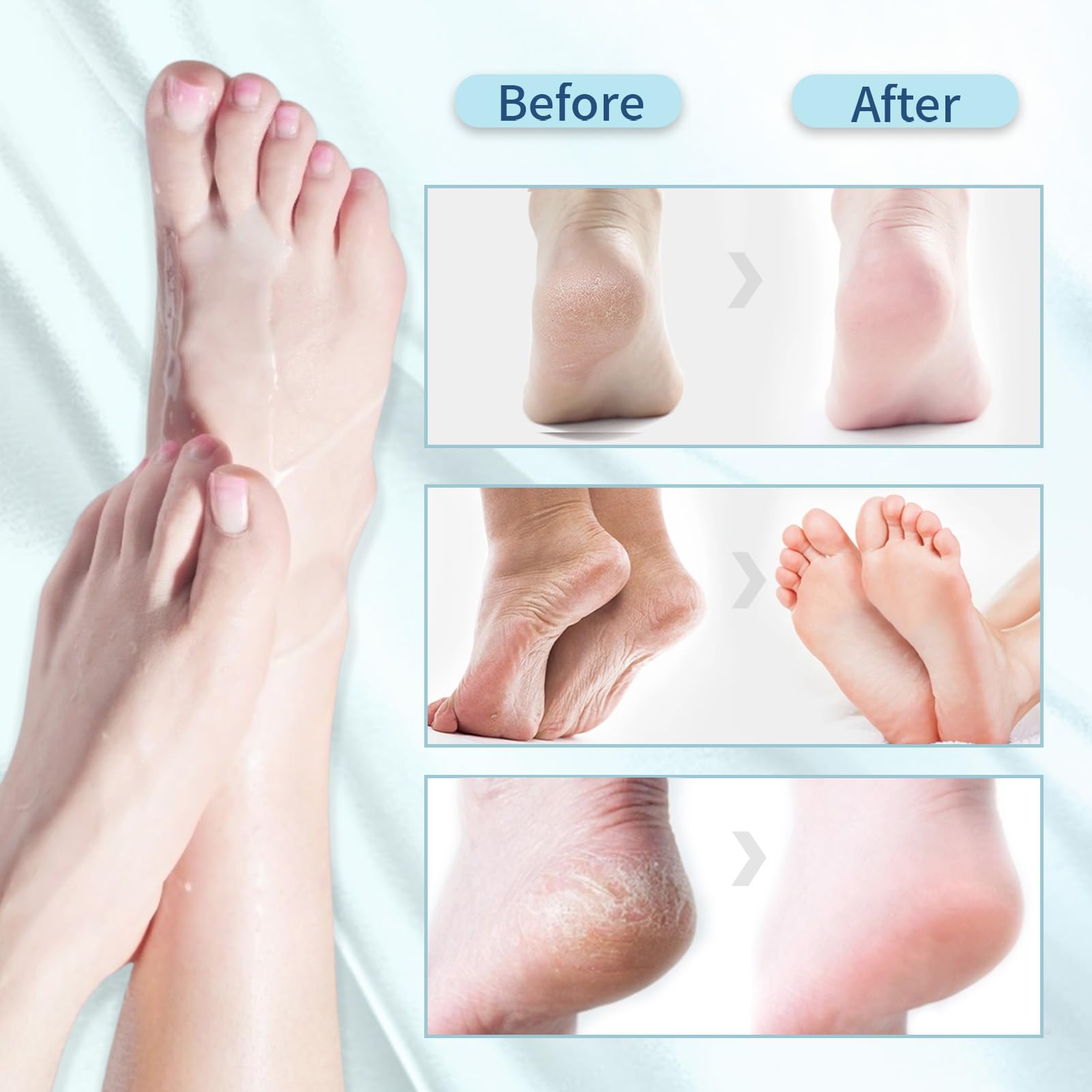 5 paia Maschera Esfoliante Piedi,Peeling Piedi,Idratante,Secchi e Screpolati,con Strumenti Pedicure per Uomo e Donna