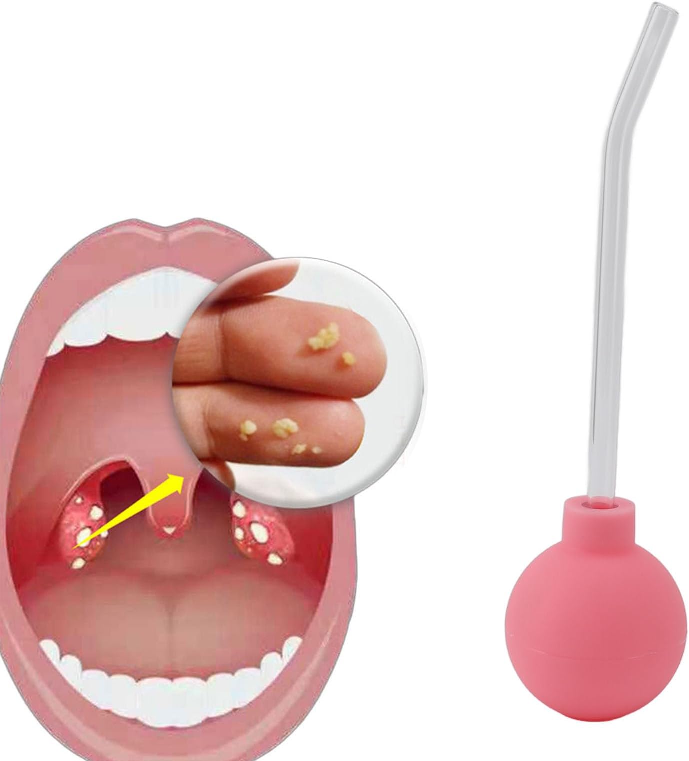 Tonsil Stone Remover, Tonsil Stone Remover Vacuum for Treating Bad Breath, Tonsil Stone Suction Device, Oral Odor Treatment for Adults, Throat (Pink)