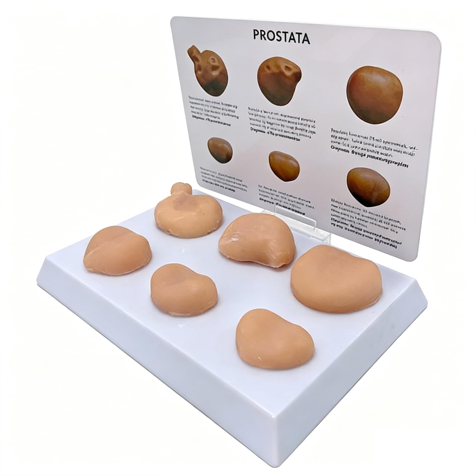 Whoolefun Men's Prostate Model Set With Pathologies, Prostate Palpation Anatomy Model, Reproductive System Lesion Training Tool, With Annotation Card, For Study Display