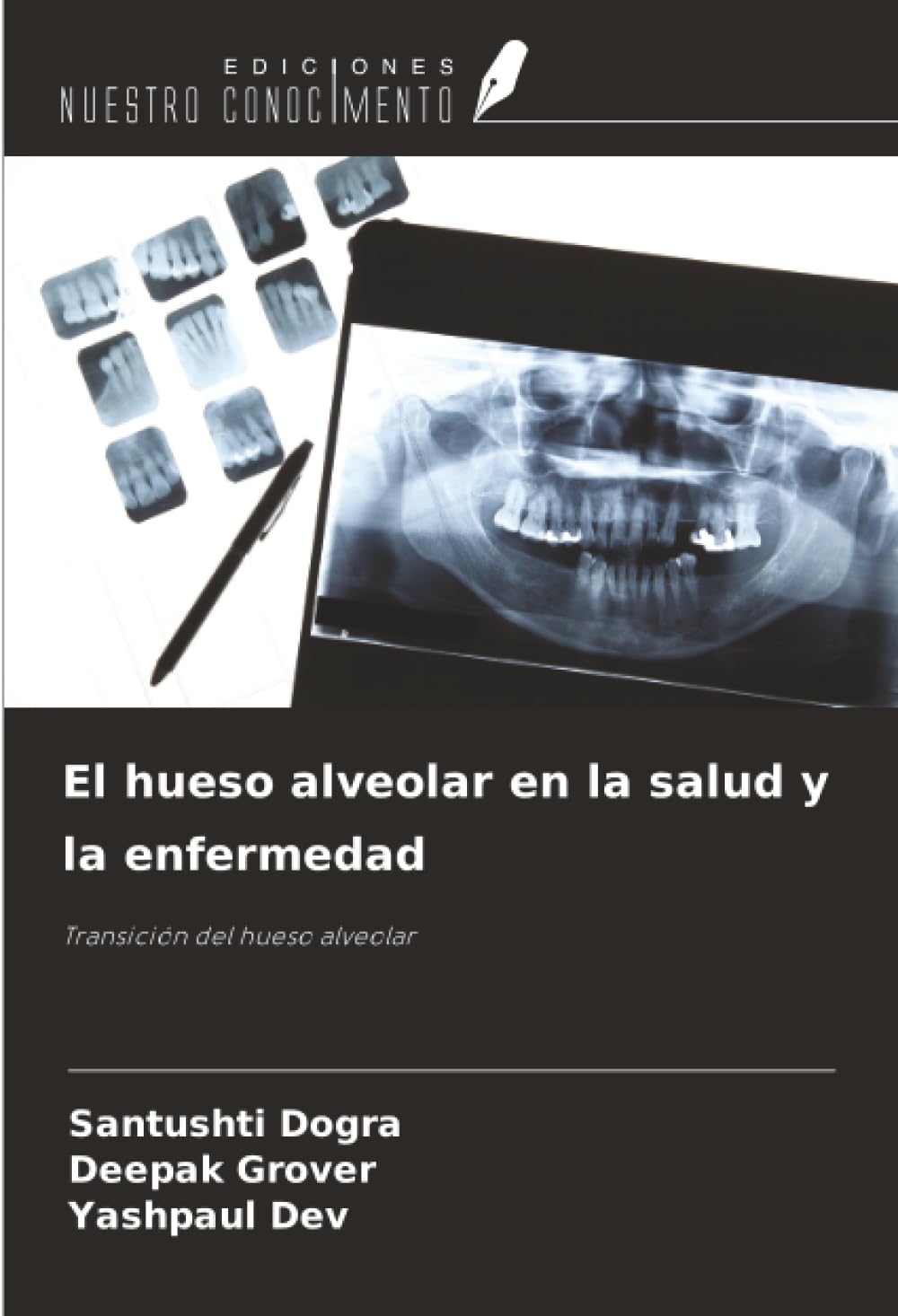El hueso alveolar en la salud y la enfermedad: Transición del hueso alveolar