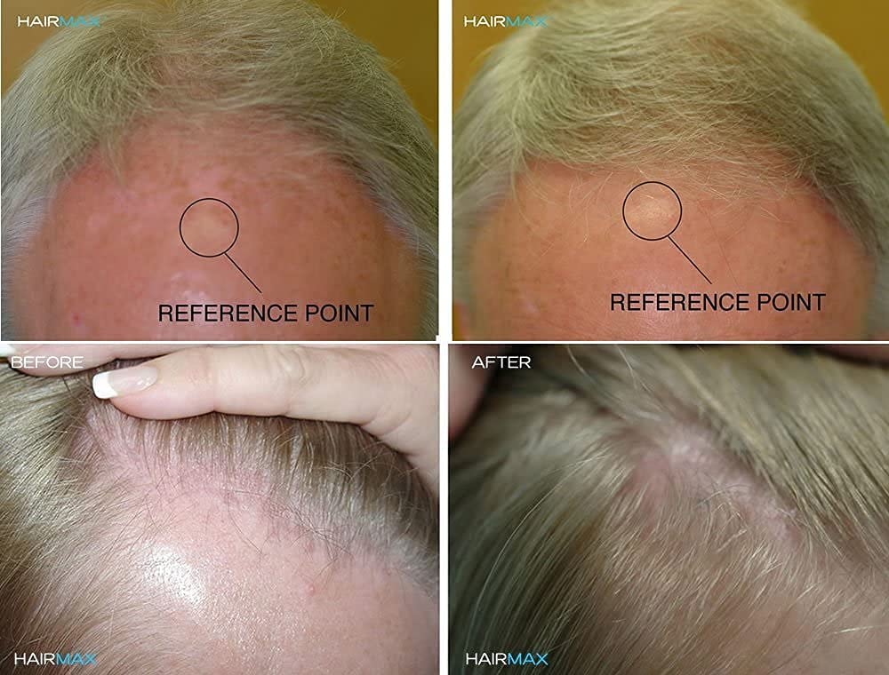 HairMax RegrowMD Laser Hair Growth Cap, FDA Cleared, 272 Medical Grade Lasers, Hair Loss