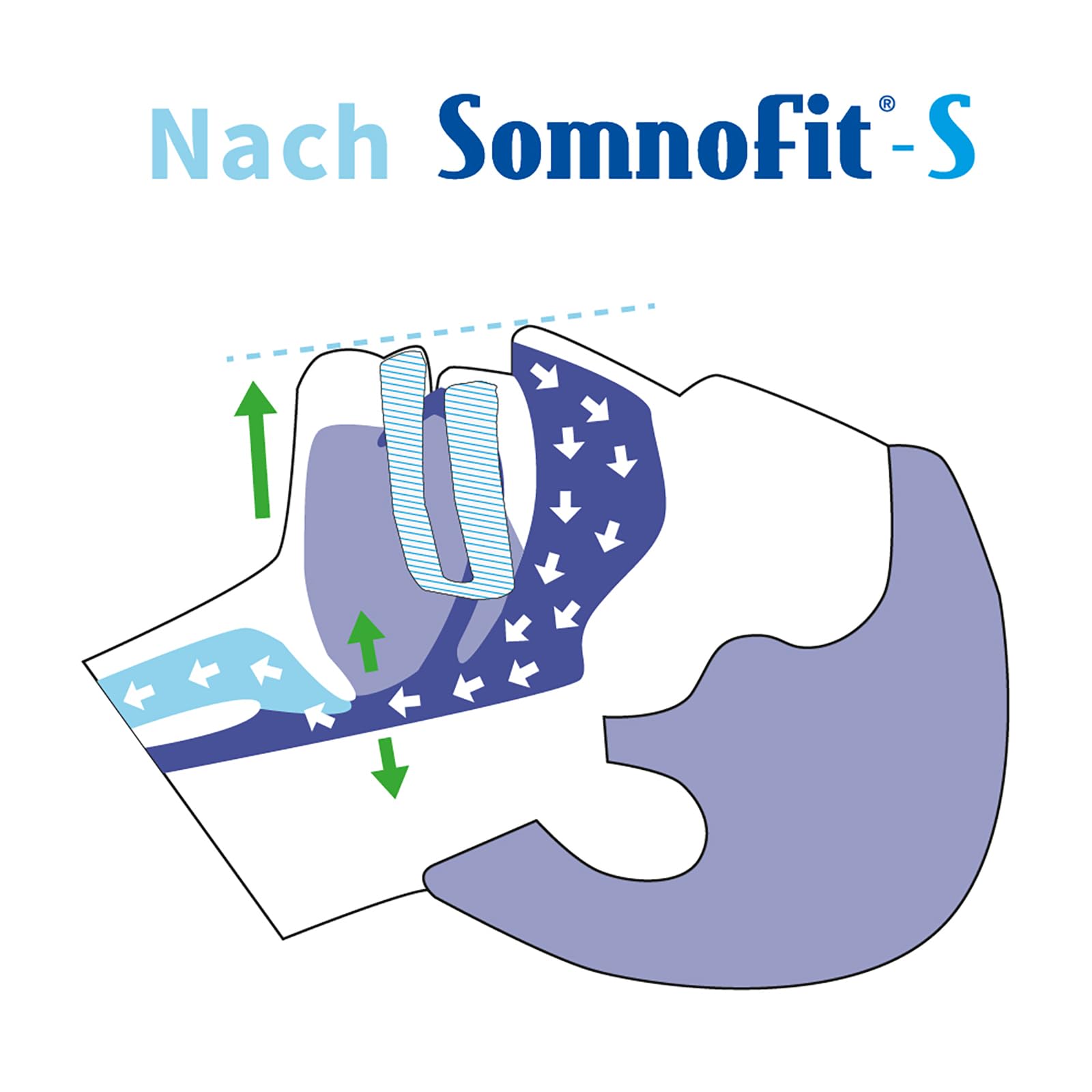 Schnarchstopper Somnofit-S - Anti-Schnarchschiene (SomniShop-Set mit Ratgeber)