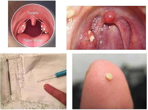 Miniatura 4 de Airgoesin 2 juegos de 6.75 pulgadas linterna amígdalas piedra removedor de extracto de piedras de garganta herramienta para tratamiento de selección