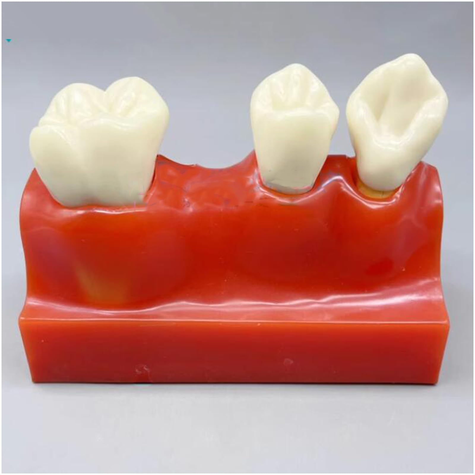 4-Faches Zahnimplantat-Modell – Zahnarztpraxis Implantat-Modell – Für Labor-Dental, Pädagogische Analyse