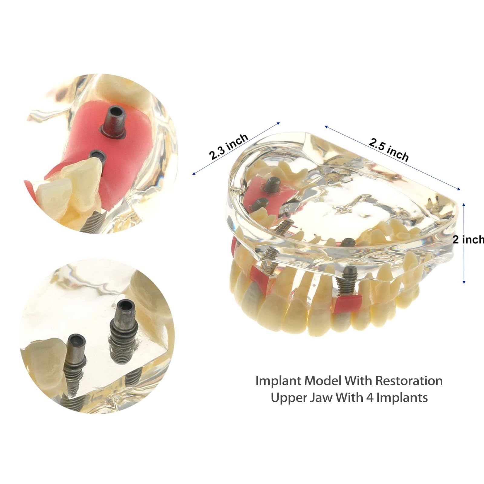Impianto Dentale Typodont Modello per Restauro e Trattamento Dimostrazione, Strumento Educativo per Studio e Insegnamento in Odontoiatria