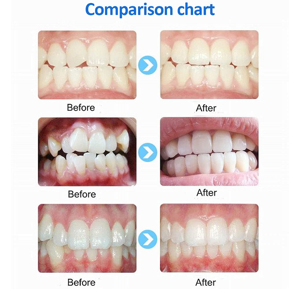 2er-Set Dental-Mundöffner Aus Silikon – Autoklavierbar Bis 134°C, Für Zahnaufhellung, Wangenhalter & Inspektion (rosa)