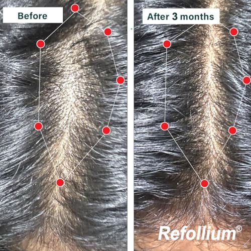 Image of Refollium Hair Vitamin Tablets with Biotin, Iron & DHT Blocker, Vitamin E for Hair Growth & Hair Fall Control, with Hair Growth Supplements for Women & Men 30 Tablets (PACK OF 2)