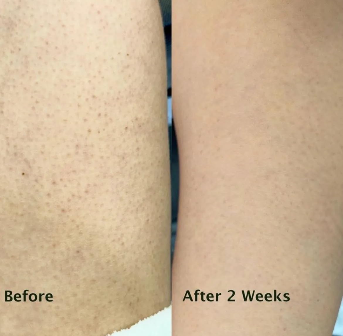 Gommage Corps Exfoliant kératose pilaire traitement, peau de fraise et poils incarnés – peeling chimique (AHA/BHA) + physique à double action à l’acide salicylique, acide glycolique et noyau d’abricot