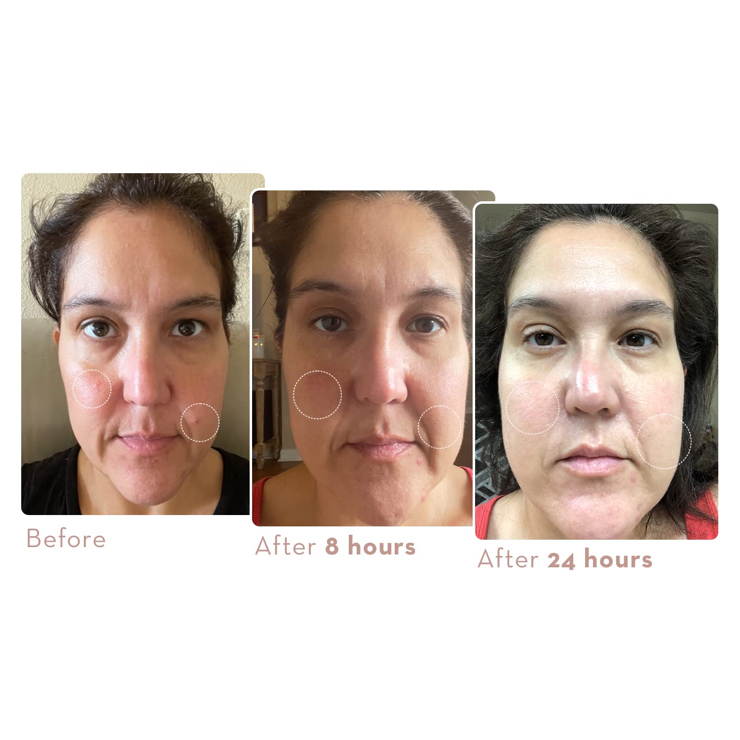 Sonage Zitlox Salicylic Acne Gel: Spot Treatment with Tea Tree Oil | Clears Acne Blemishes | Benzoyl Peroxide Alternative