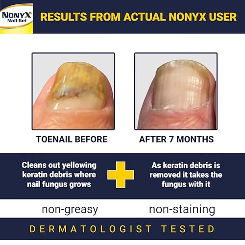 NONYX Fungal Nail Clarifying Gel Clears out Fungus by Removing