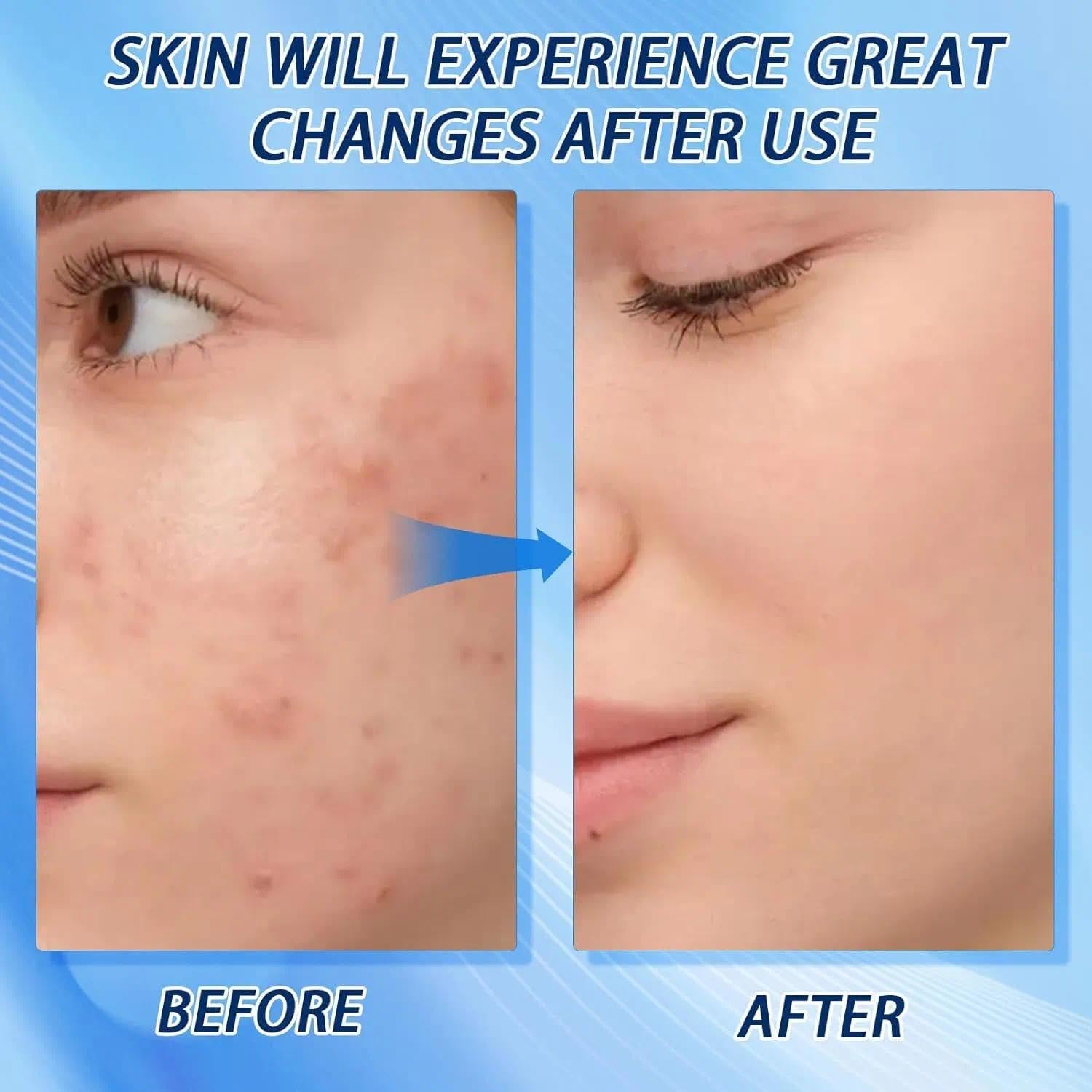 4% Acne Gentle Hydrating Face Cleanser for Women Sensitive Face Wash with Hyaluronic Acid - Image 2