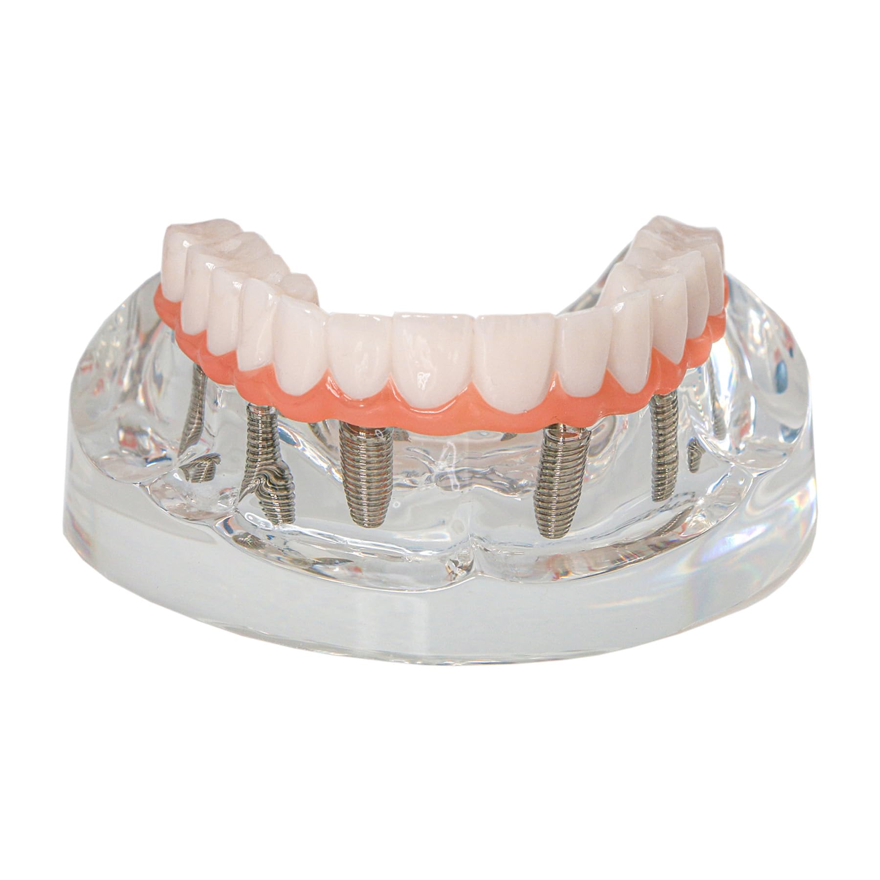 Dental Implant Teaching Model, Upper Jaw with 6 Implant Posts and Prosthetic Bridge, Clear Base