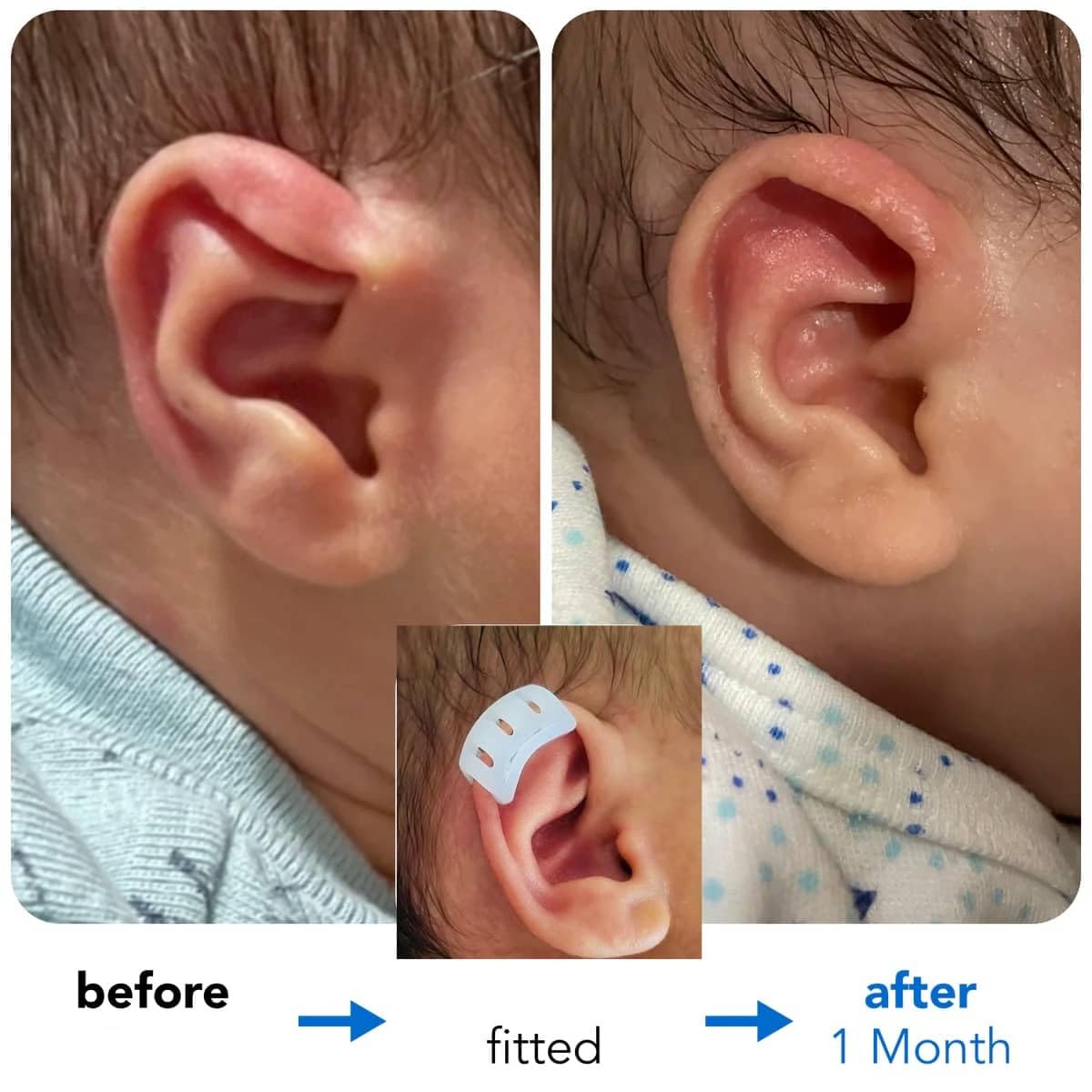 Infant Lop Ear Deformity Correction Clip For Newborn Baby Fixing Auricle Valgus Patch Stickers Children Ear Shape Aesthetic Corrector Without Surgery product thumbnail 7