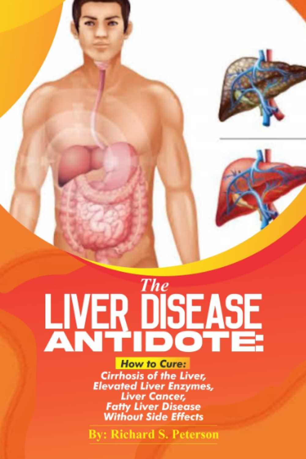THE LIVER DISEASE ANTIDOTE:: How to Cure Cirrhosis of the Liver, Elevated Liver Enzymes, Liver Cancer, Fatty Liver Disease Without Side Effects