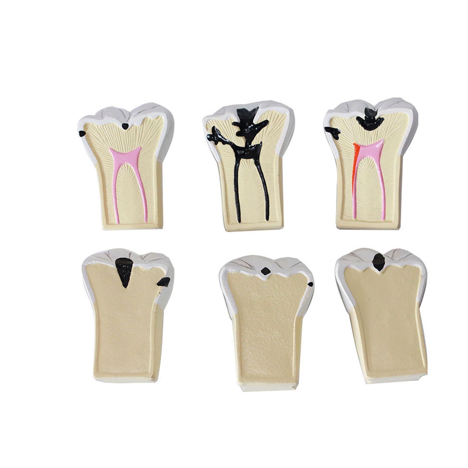 Modelli di comparazione della Carie 4 Volte Modello di decomposizione della Carie Denti sezionati Modello per la Ricerca didattica Modello di Studio per Studenti di odontoiatria