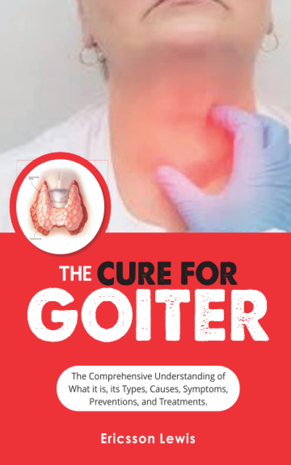 THE CURE FOR GOITER:: The Comprehensive Understanding of What it is, it Types, Causes, Symptoms, Preventions, and Treatments