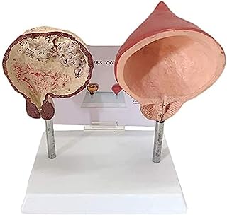 Study Model Medical Anatomical Bladder Model Comparison Model of Smoking Bladder and Normal Bladder Human Organ Anatomy Model Human Urinary System Model for Study Display Teaching,A SaiFei