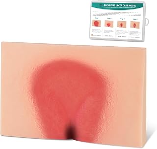 Decubitus Ulcer Wound Care Model, Bedsores Model, Pressure Injury Model for Medical Training Practice, Stage 1