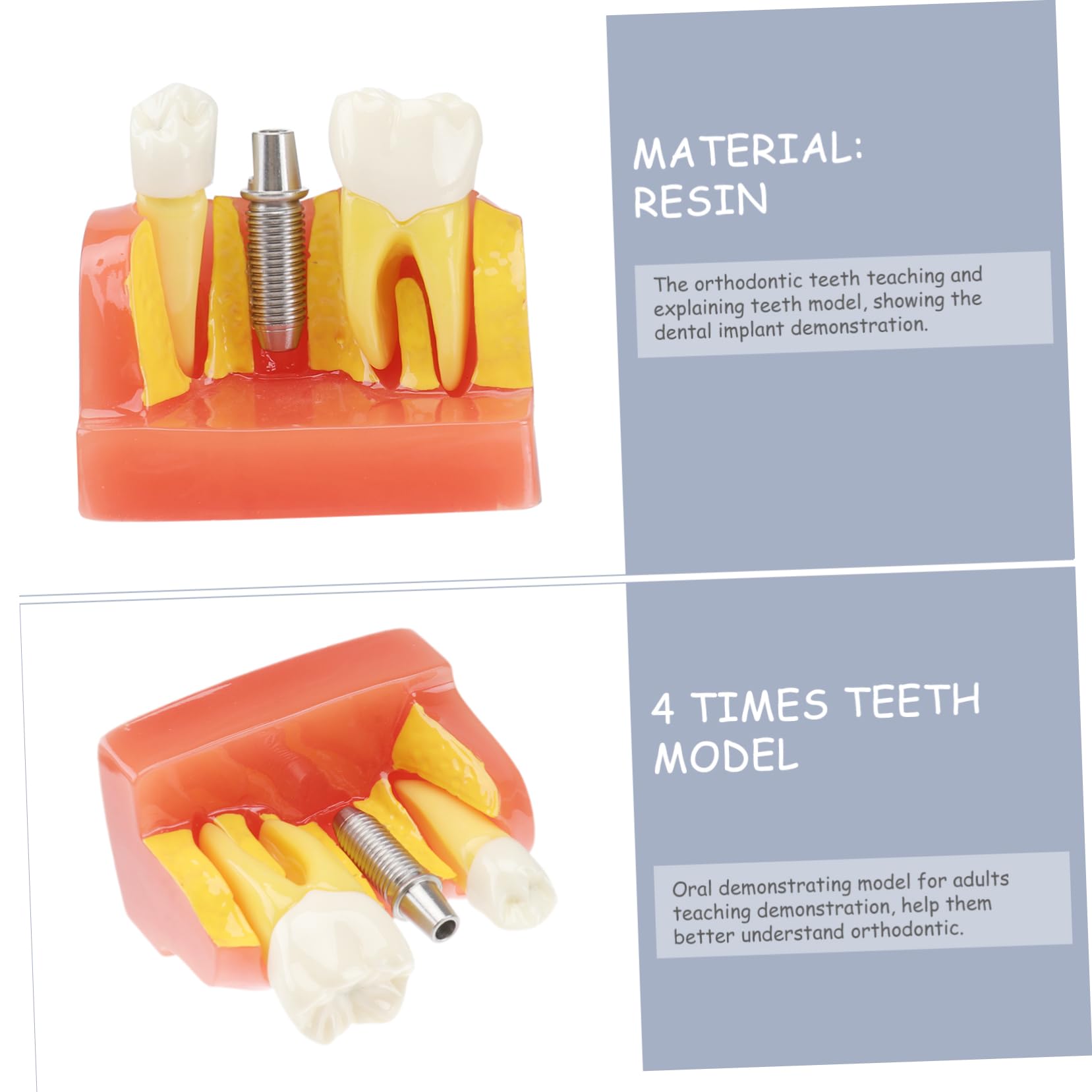 1pezzi Modello di Denti con Denti Rimovibili Strumento Didattico per Insegnamento e Studio Odontoiatrico Modello di Impianto e Protesi Fissa Incluso