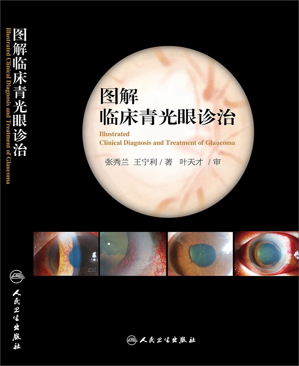 GLAUCOMA 第2版 volume 2のみ Glaucoma, 2nd ed., in 2 vols.: 洋書／南江堂