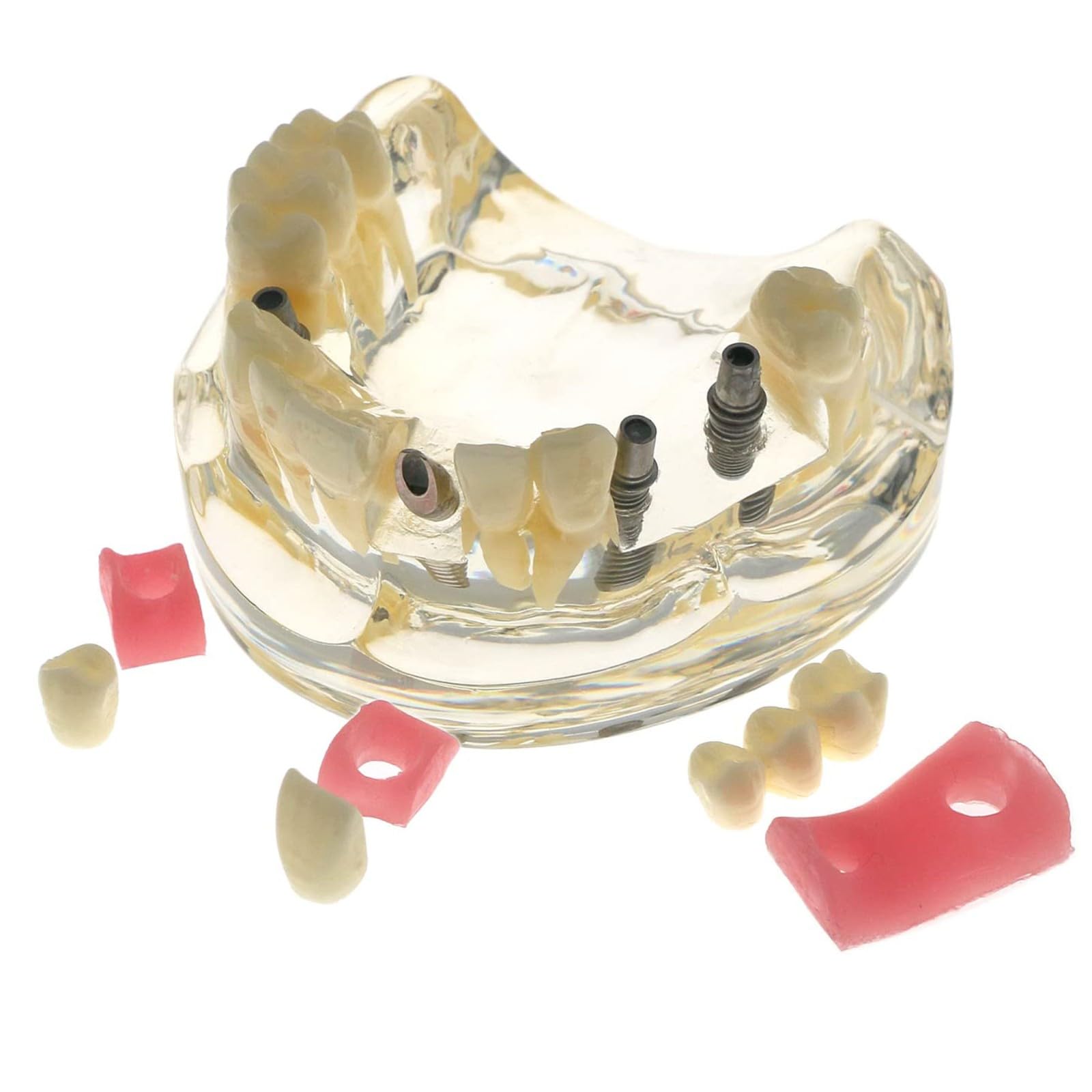 Impianto Dentale Typodont Modello per Restauro e Trattamento Dimostrazione, Strumento Educativo per Studio e Insegnamento in Odontoiatria