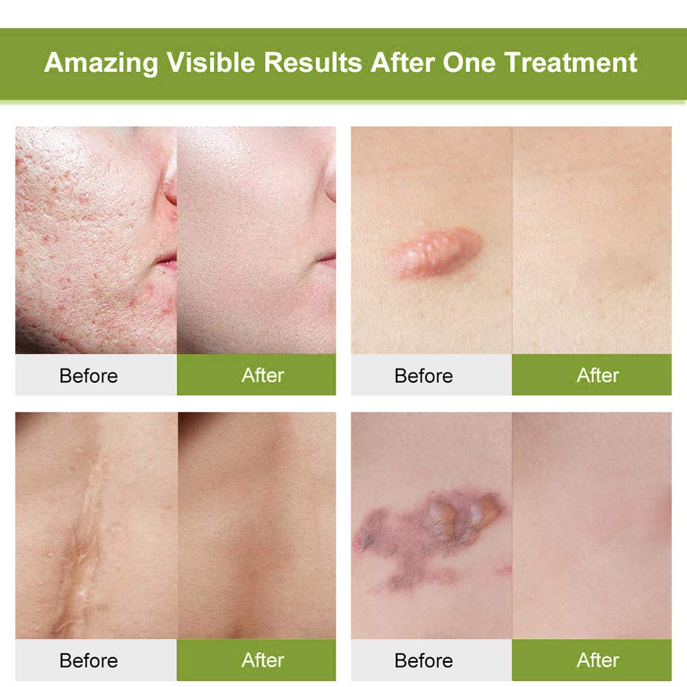 Acne Scar Removal Gel, Acne Scar Treatment, Skin Repair Gel, Scar