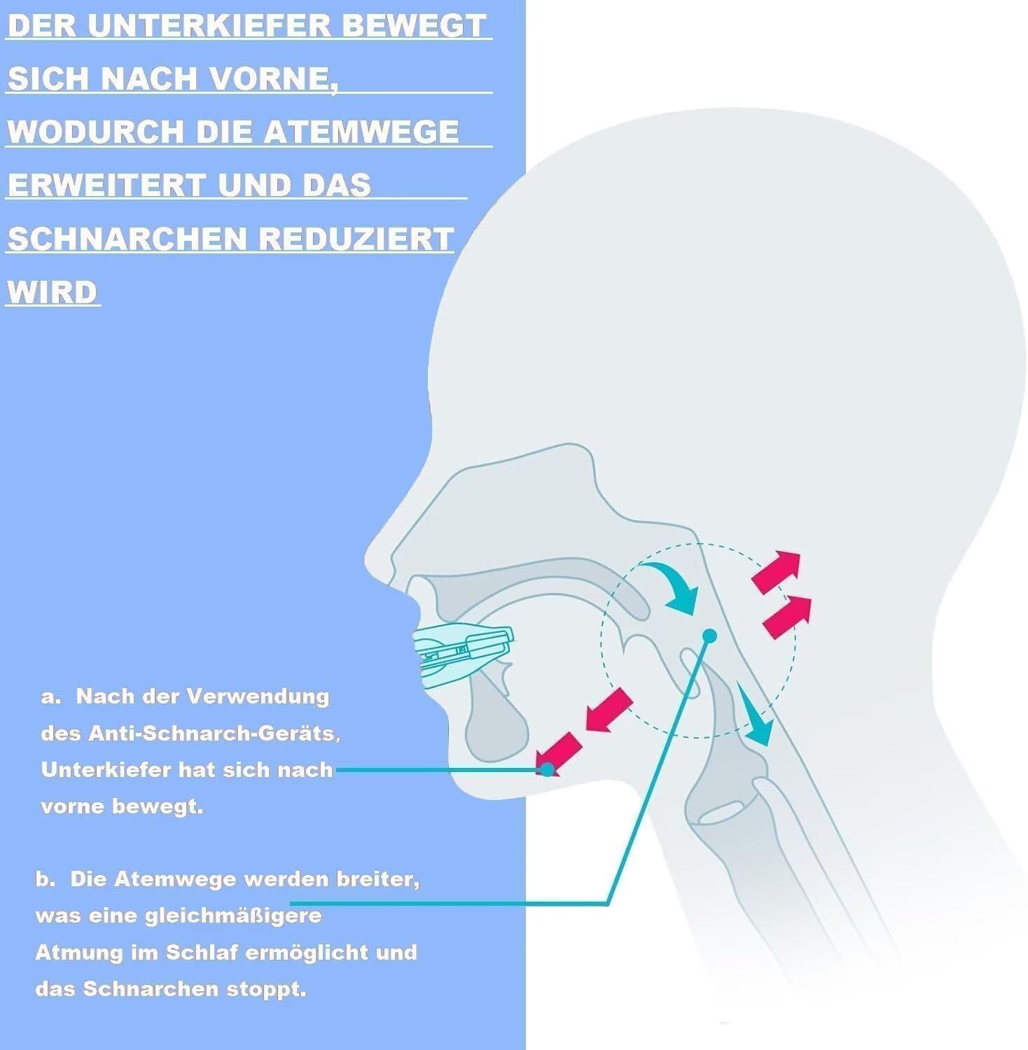 Sleepzee Anti-Schnarch-Mundstück Adjustable Schnarchschiene für Männer und Frauen (Blau)