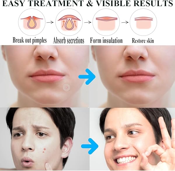 Zemolo 300 PCS Patches For Pimple,Pimple Patch Patches Acne Hydrocolloid Invisible Absorbent Cover,Day And Night Use In One, - 5