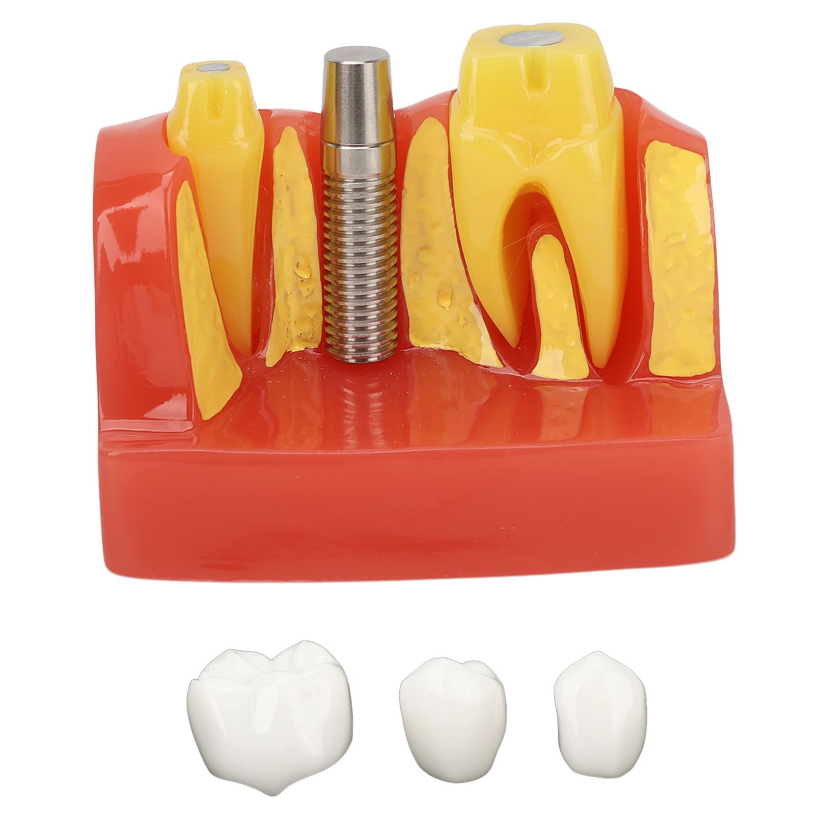 Modelo de implante Dental con Corona y Puente extraíbles para demostración y formación