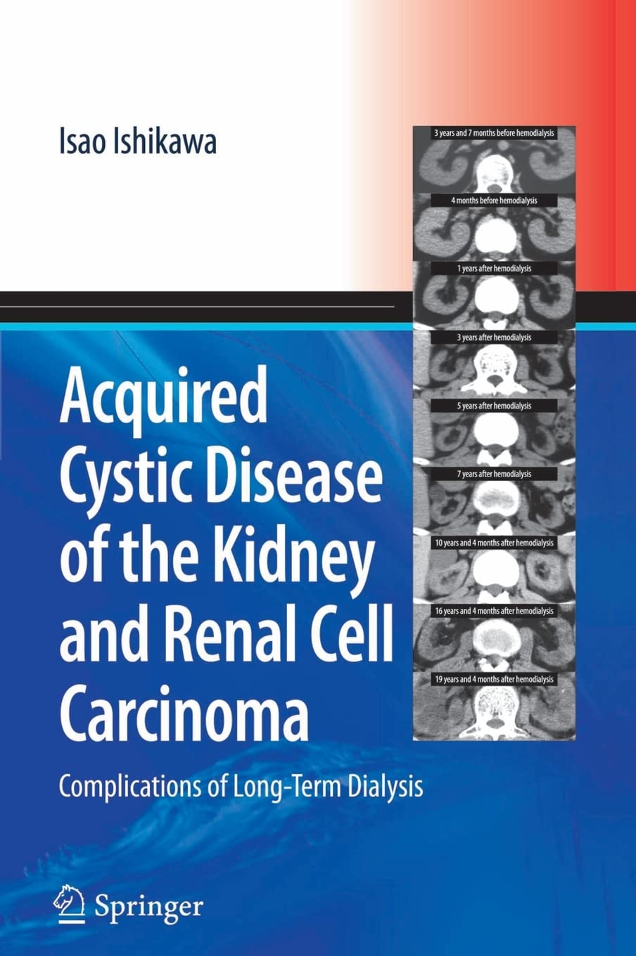 Acquired Cystic Disease of the Kidney and Renal Cell Carcinoma: Complication of Long-Term Dialysis