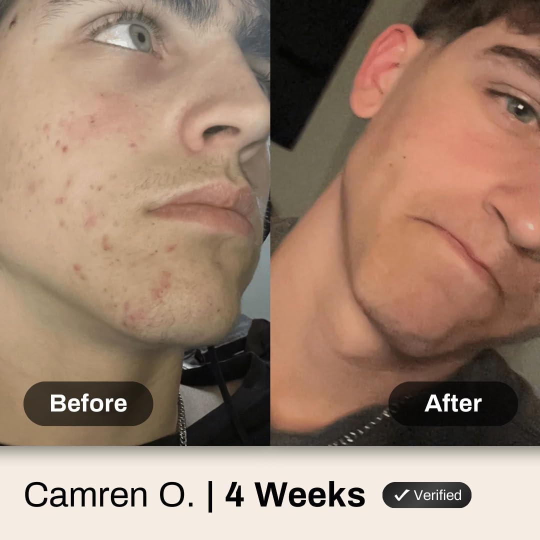 Acne System for Men and Boys, Face Wash, Moisturizer, Pimple Patches, Shield Men's Skin Care Set (2 Months)