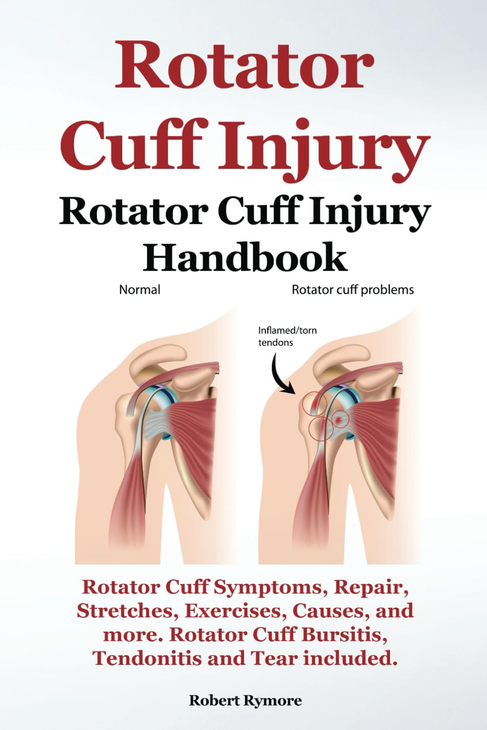 Rotator Cuff Injury. Rotator Cuff Injury Handbook. Rotator Cuff Symptoms, Repair, Stretches, Exercises, Causes and more. Rotator Cuff Bursitis, Tendonitis and Tear included.