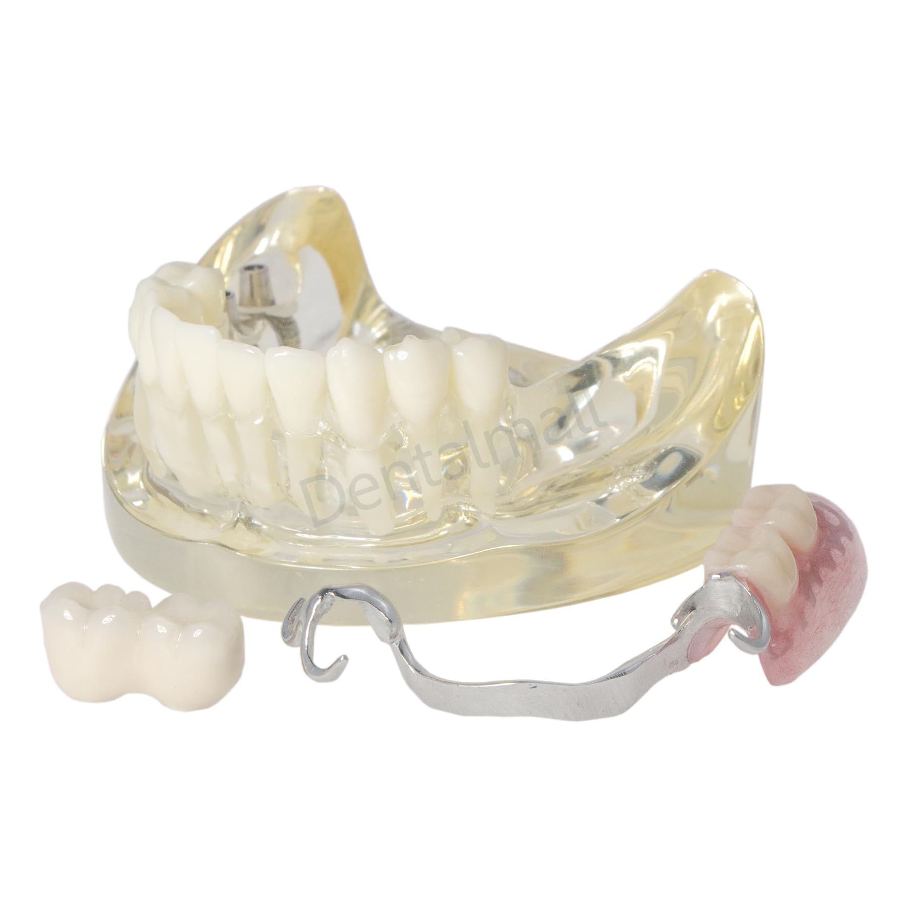 Dental Typodont Restoration Model with 2 Implants Partial Denture Demo M6022
