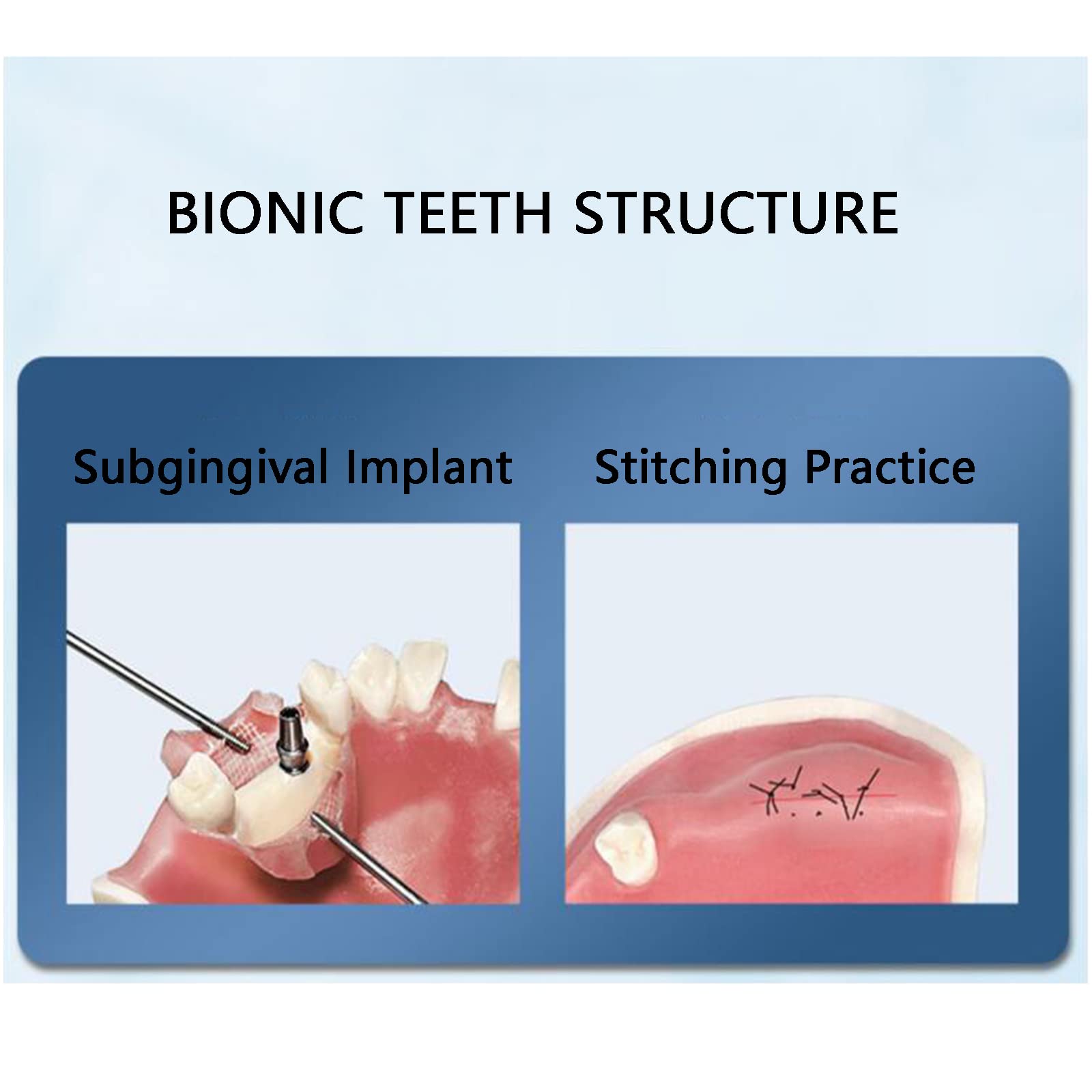 Modello di impianto Dentale mascellare - Modello di Studio Modello di Denti per Adulti - Modello didattico Esercizio di sutura implantare Otturazione mascellare Modello di Imp