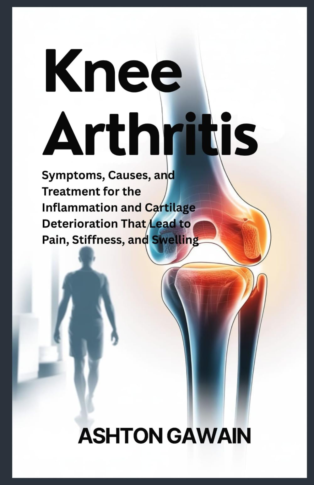 Knee Arthritis: Symptoms, Causes, and Treatment for the Infl ammation and Cartilage Deterioration That Lead to Pain, Stiffness, and Swelling