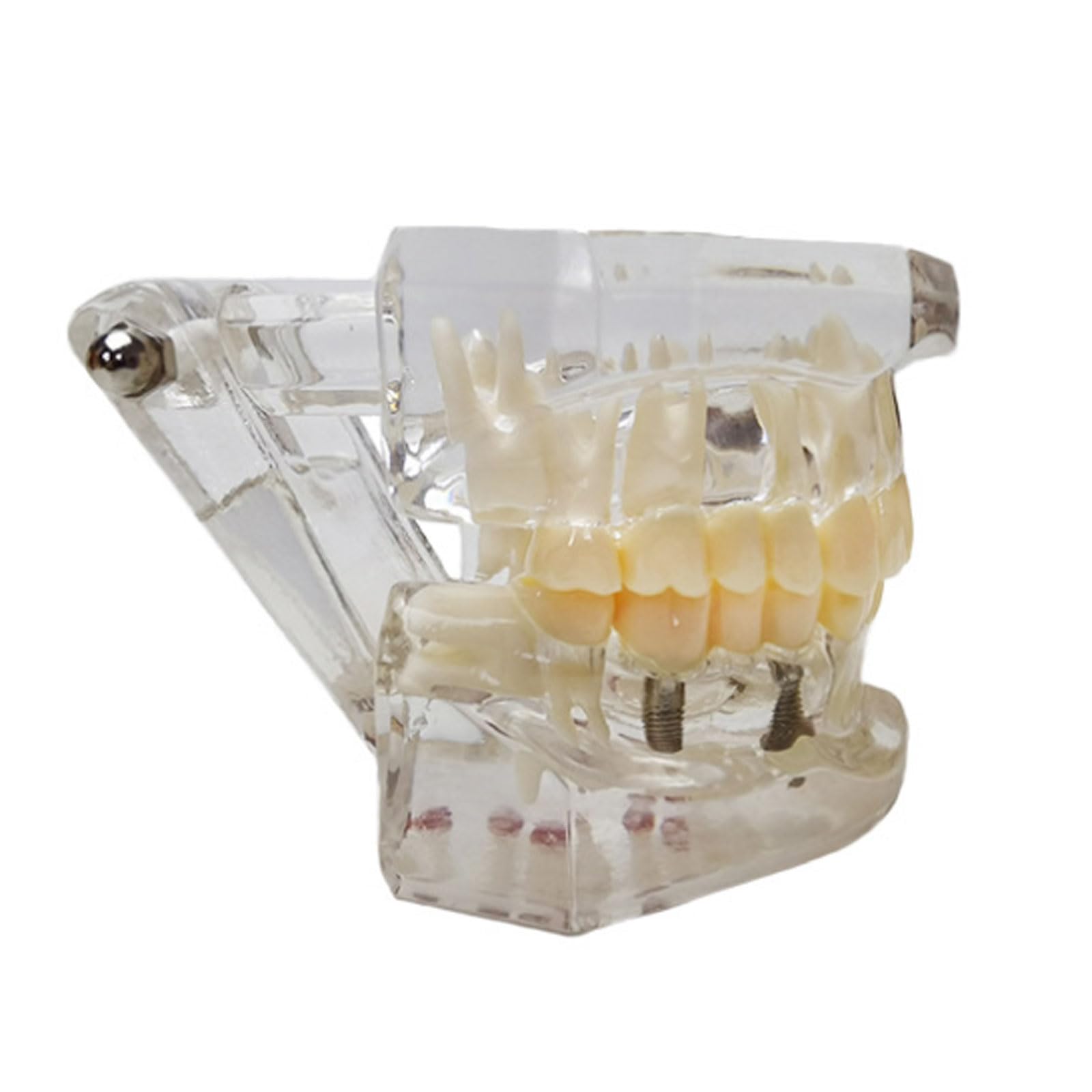 Modello Dentale Denti Impianto Restauro Ponte Insegnamento Studio Scienza Medica Malattia Dentista Odontoiatria Prodotti Regalo Dentale