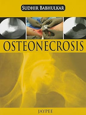 OSTEONECROSIS