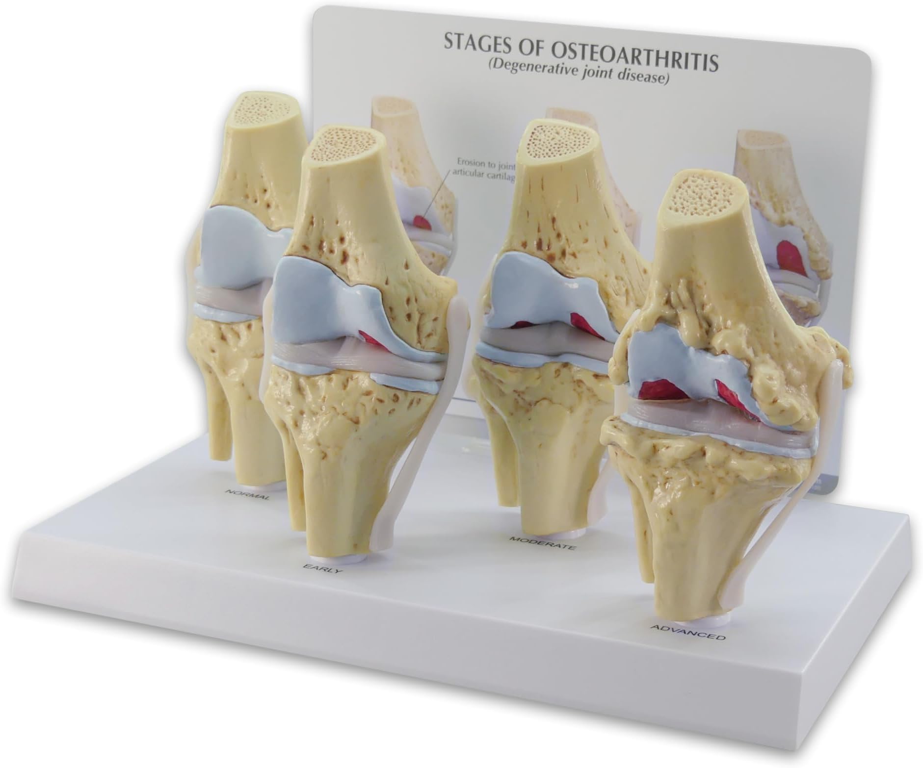 Knee Set 3/4 size Osteoarthritis Set of 4 Anatomical Model w Educational Key Card