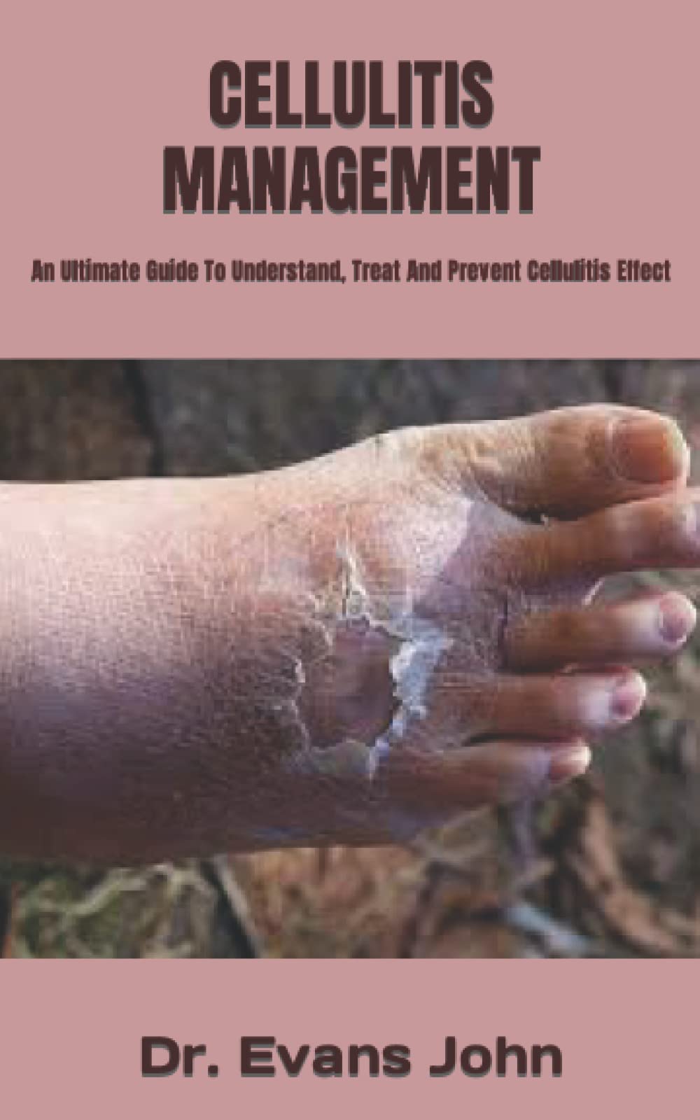 Buy CELLULITIS MANAGEMENT An Ultimate Guide To Understand, Treat And