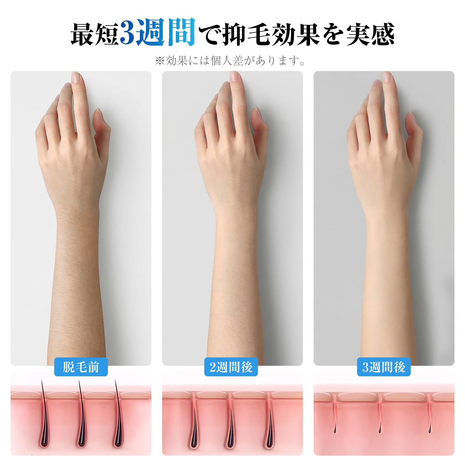 Amazon | 【iF賞受賞・PSE認証】脱毛器 VIO対応 メンズ【次世代HIPL