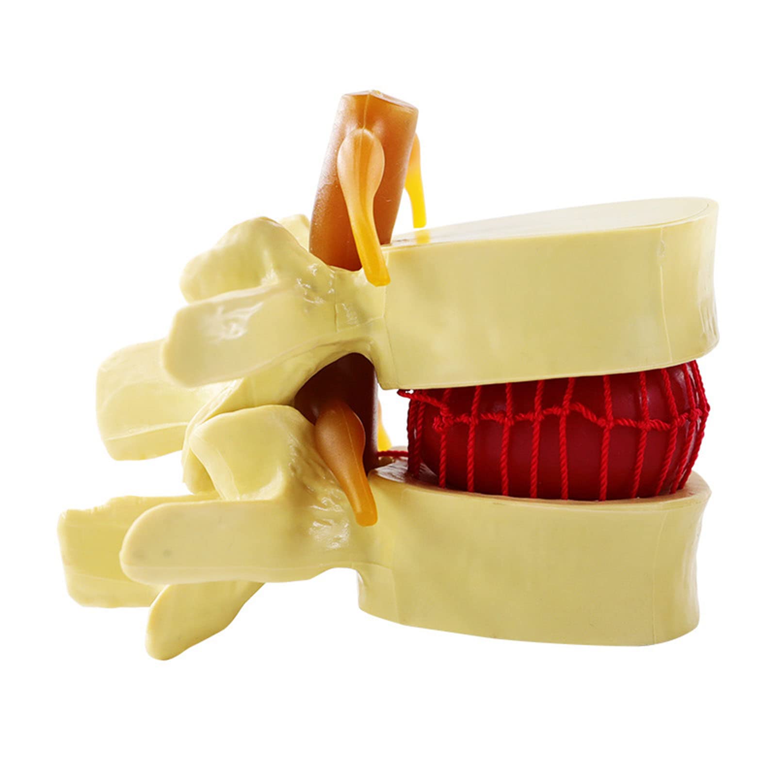 GTHTUHFD Human Lumbar Disc Herniation Model Human Lumbar Disc Herniation Demonstration Model Plastic Human Lumbar Disc Herniation Model .99 .99,Yellow