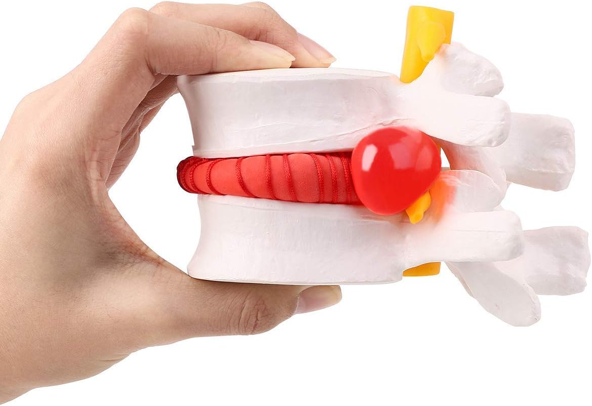 Human Anatomical Lumbar Disc Herniation Model - Lumbar Spine Model for Teaching & Learning - Excellent Way for Demonstrating Disc