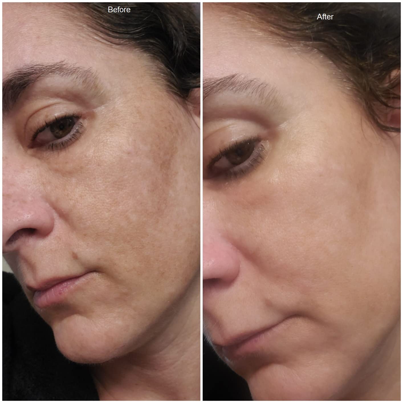 Amazon Com Admire My Skin Dark Spot Corrector Remover For Face Brightening Serum Fade Cream Melasma Treatment Cream With Synovea Kojic Acid Vitamin C Salicylic Acid Azelaic Acid Lactic Acid Serum