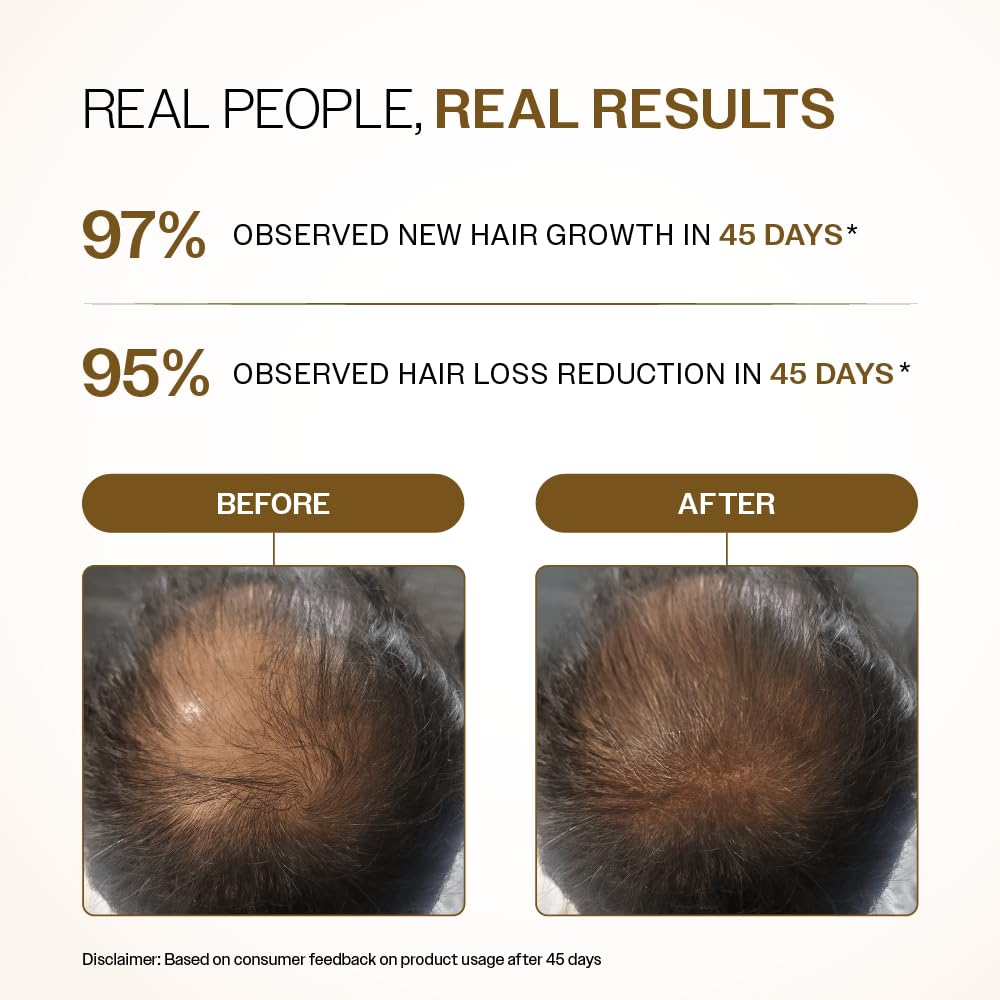 Bare Anatomy Advanced Hair Density Roll-On | 3% Redensyl + 4% Anagain + 2% Baicapil + 5% rosmarino, acqua di riso, biotina e saw palma | 25 ml
