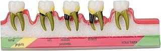Teeth Model, Teeth Periodontal Disease Model Different Stages Resin Dental Periodontitis Display Model Dental Caries Tooth Models Teaching Learning Tools for Dentist Education