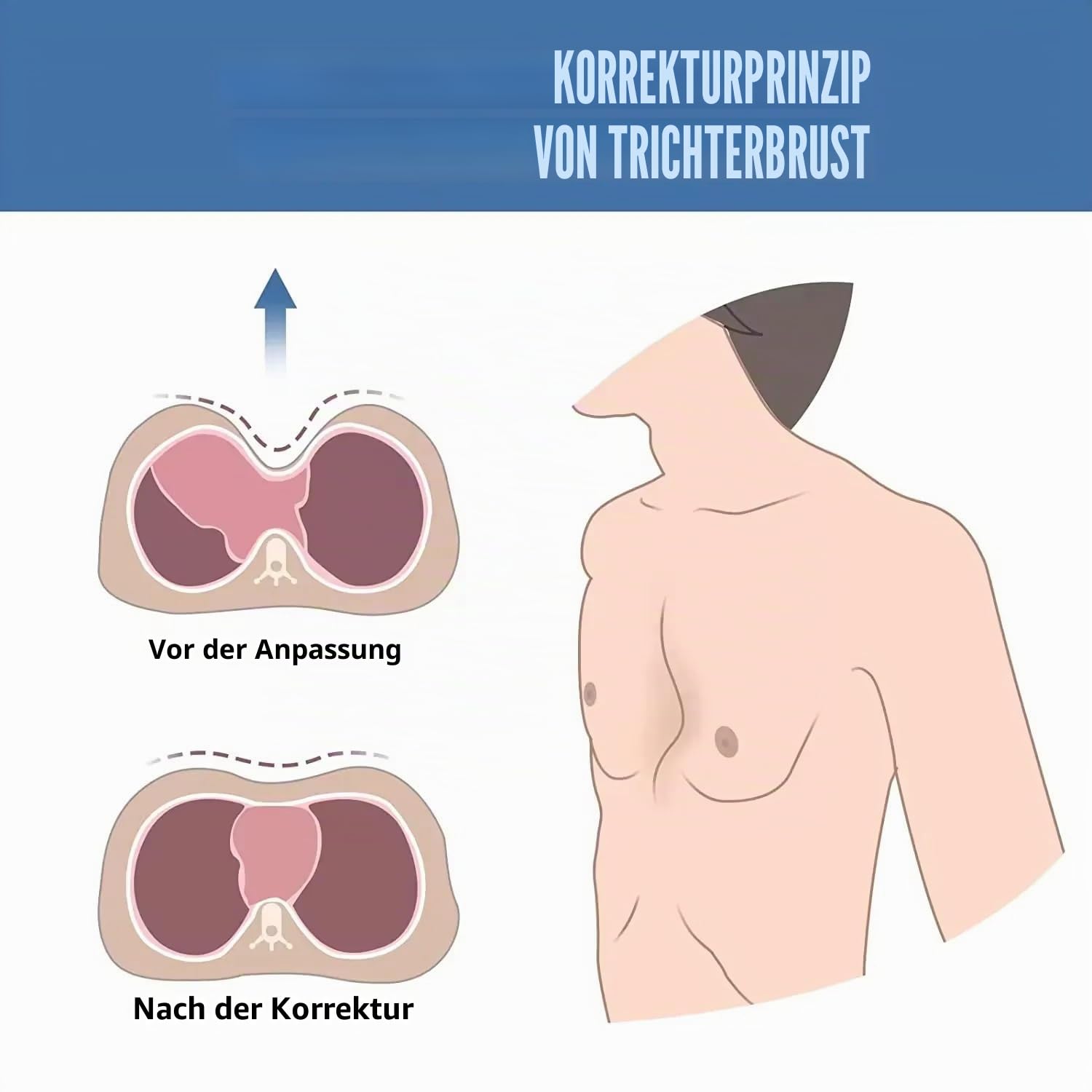 Trichterbrust-Orthese Thoraxdepressionsorthese Trichter-Sternumdepressionsstütze für alle Kinder und Erwachsene (S)