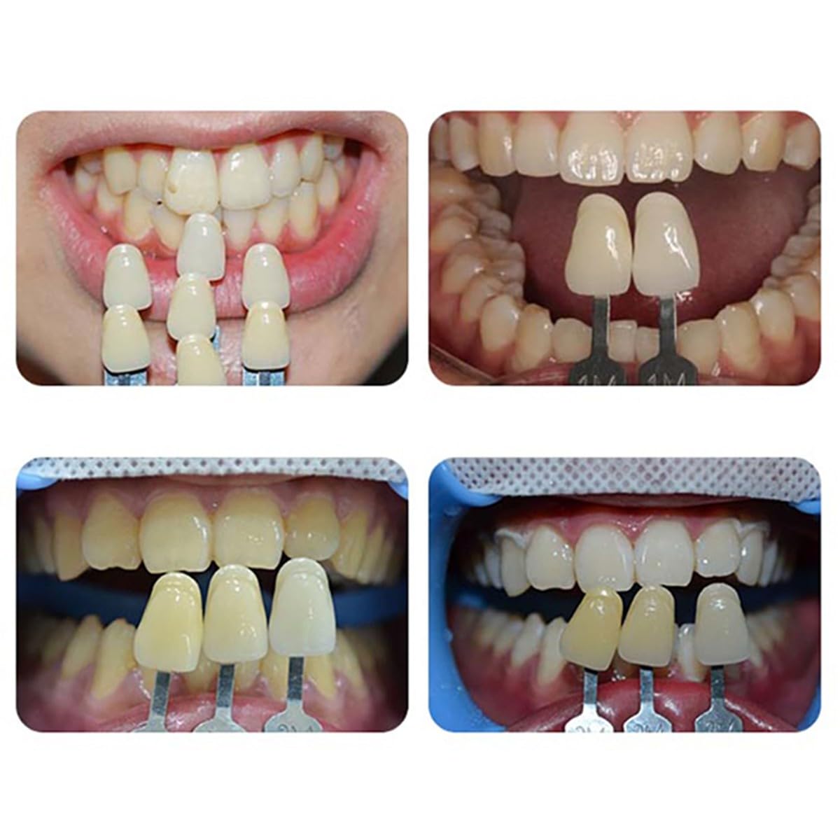 29 Colori Sbiancamento Dei Denti Scala Colori Tabella Colori Sbiancamento | Denti Professionale 3D